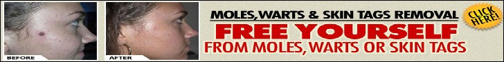 Moles, Warts & Skin Tags Removal